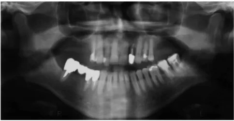Figure 3Pre-operative panoramic radiographPre-operative panoramic radiograph.
