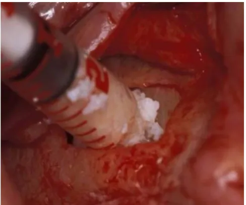 Figure 4ite materialSinus floor augmentation with the biphasic calcium compos-Sinus floor augmentation with the biphasic calcium composite material.