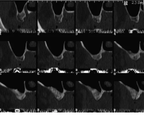 Figure 6Dental-CT: Layers B1 – B12 = regio 18 – 14; Distance between the layers: 2Dental-CT: Layers B1 – B12 = regio 18 – 14; Distance between the layers: 2.5 mm (1:1).