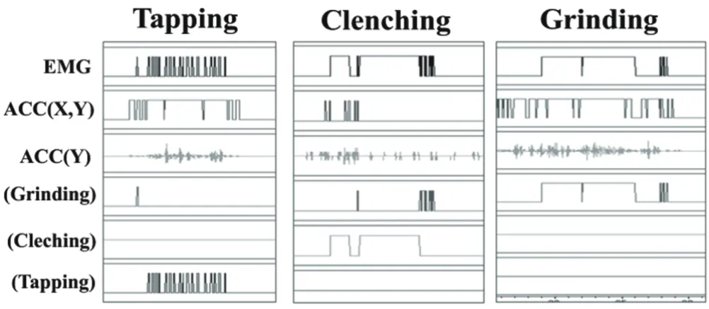 Figure 3Characterization of different patterns of bruxism activitiesCharacterization of different patterns of bruxism activities