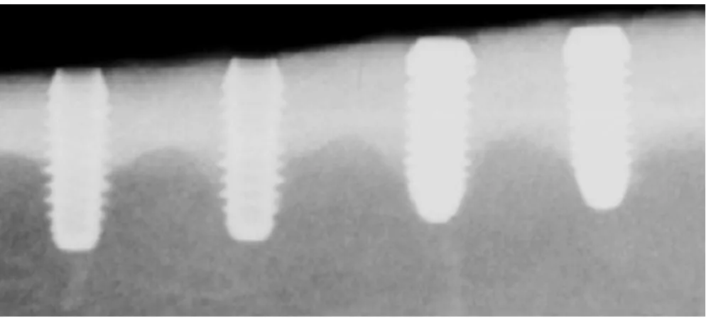 Figure 1Radiograph showing titanium (left) and zirconia (right) implants inserted into the tibia of minipigs after 12 weeks of healing timeRadiograph showing titanium (left) and zirconia (right) implants inserted into the tibia of minipigs after 12 weeks of healing time.
