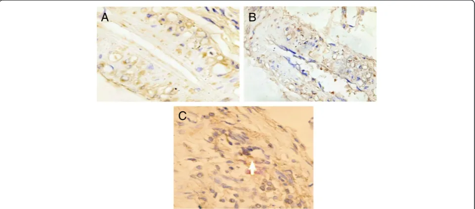 Figure 7 Immunohistochemistry detection of VEGF: VEGF expression in endothelial cells of interstitial tissue decreased in DN group(7B) compared to the control group (7A)