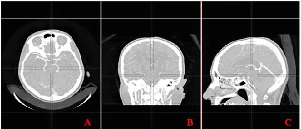 Figure 6. Three-dimensional segmented brain. 