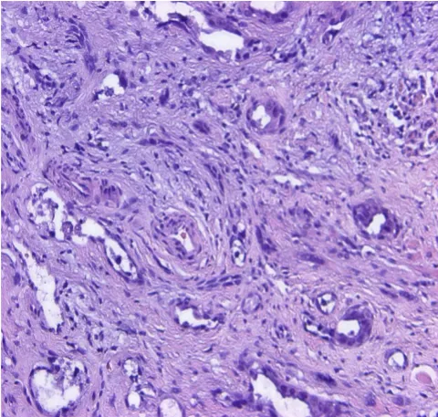 Figure 2illary growth pattern (H&E, ×150)Oral acantholytic squamous cell carcinoma: capillary and pap-Oral acantholytic squamous cell carcinoma: capillary and papillary growth pattern (H&E, ×150).