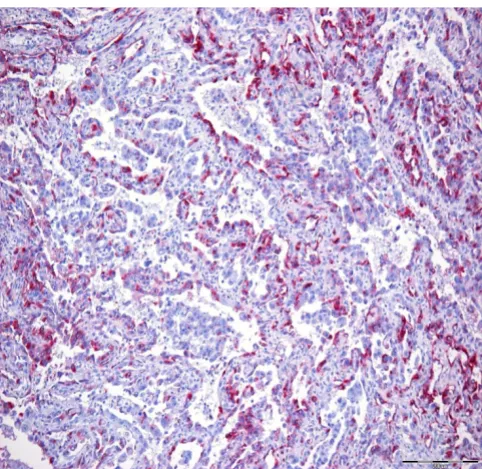 Figure 7Fli-1 in a subset of the tumour cells (×150)Oral angiosarcoma: immunohistochemical demonstration of Oral angiosarcoma: immunohistochemical demon-stration of Fli-1 in a subset of the tumour cells (×150).
