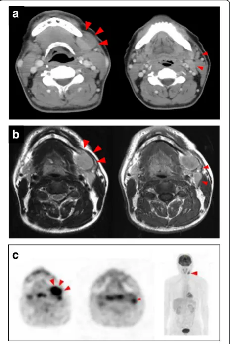 Fig. 2 CT scan (region associated with enlarged submental lymph nodes (arrowheadabnormal accumulation of FDG in the left submandibular (arrowheada) and Contrast-enhanced T1-weighted MRI (b)revealed an oval swelling (Large arrowhead) in the left submandibul