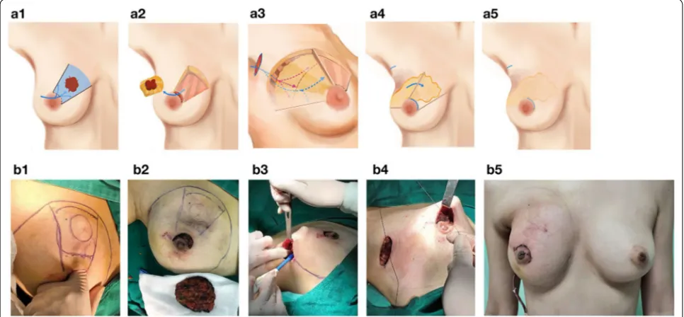 Fig. 1 Atlas of scarless oncoplastic breast-conserving surgery. a1, b1 The location of the tumor, as well as the planned excision region, were marked on the skin of the breast, and a semi-peri-nipple-areolar-complex incision was done to remove the tumor-co