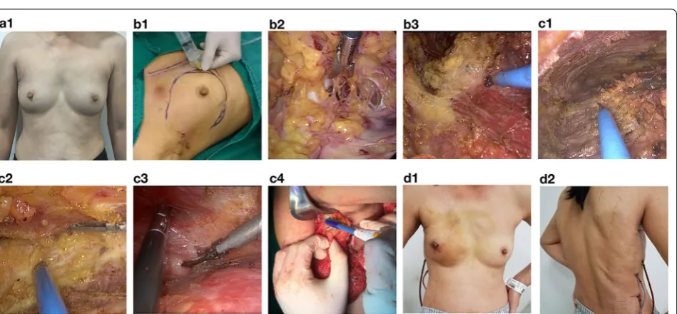 Fig. 2 Atlas of round-block technique for oncoplastic breast-conserving surgery a, b Pre-operation marking of the incision, as well as the peri-NAC area for de-epithelialization