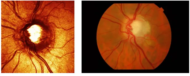 Figure 1: A patient’s eye captured by two di↵erent image modalities, showing the retinasurface and blood vessels