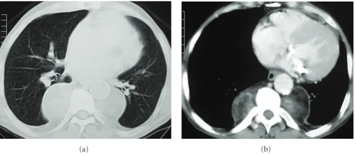 Figure 1: Anteroposterior (a) and lateral (b) chest radiographs showing large lobulated bilateral masses located in the retrocardiac region.