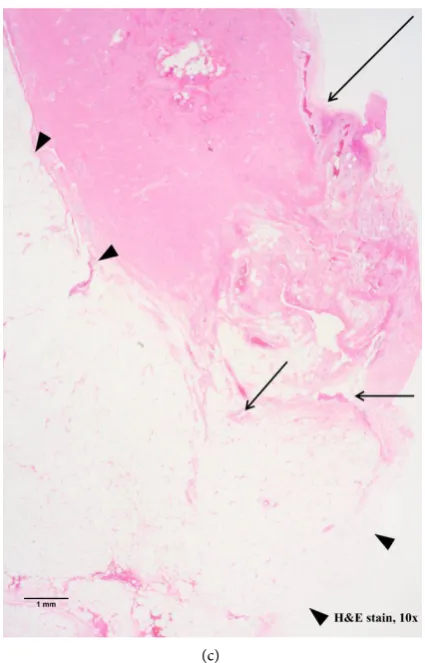 Figure 1. A 32-year-old man with EAA. (a) Axial scan of contrast-enhanced abdominopelvic fibrofatty tissue (arrowhead) containing tubular structures (short arrows) suspected as engorged vessel and fibrin components, around the tip of the appendix (arrow) (