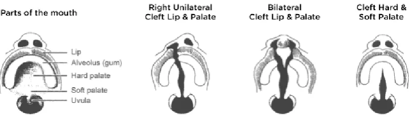 Figure 1: Classification of cleft lip and/or cleft palate.  Courtesy of the Cleft Lip and Palate 