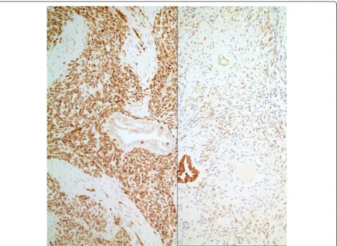 Fig. 5 Case #1. Strong bcl-2 and weak EMA expression by neoplastic cells (Left: Immunohistochemistry, anti-bcl-2 Ab x 200; Right: Immunohistochemistry,anti-EMA Ab x 200)