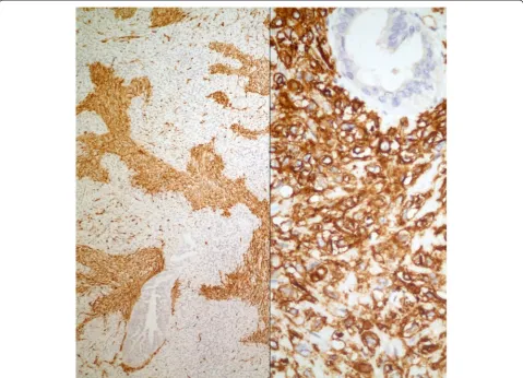 Fig. 6 Case #1. SMA stains myofibroblasts between neoplastic lobules and MUC4 stains neoplastic cells (Left: Immunohistochemistry, anti-SMA Ab x 100;Right: Immunohistochemistry, anti-MUC4 Ab x 400)