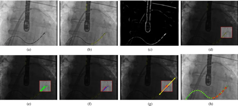 Fig. 2. Catheter extraction as an initialization in X-ray. (a) Example of an original X-ray image
