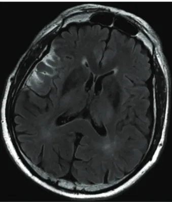 Figure 1: The four variations of the vascularization of the thalami and the midbrain described by Percheron (1: Thalami, 2: Midbrain, PCA:Posterior Cerebral Artery, VA: Vertebral Artery).