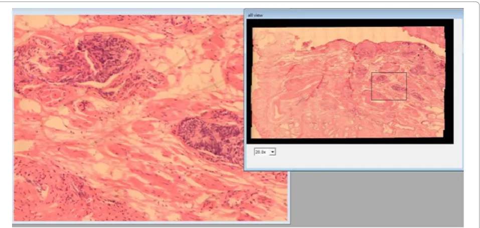 Figure 1 GUI of the virtual microscopy prototype. GUI of the virtual microscopy prototype: the figure shows the whole Virtual slide at theright panel (small magnification) while a large resolution of the black square in the VS enlargement is displayed in t