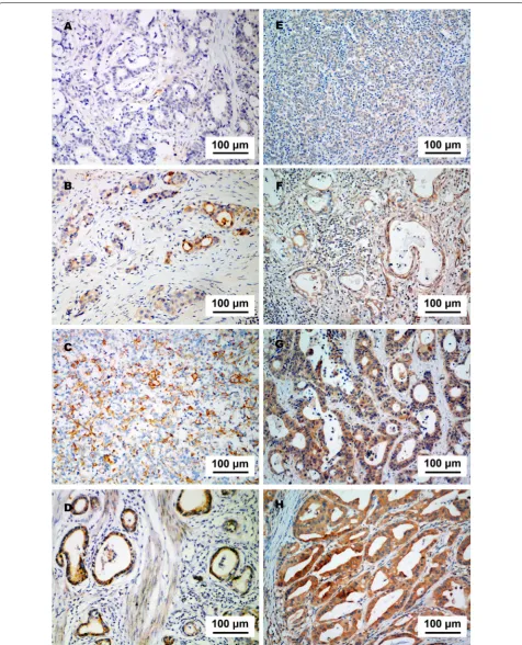 Fig. 2 PD-L1 and PD-L2 expression in a specimen of gastric adenocarcinoma. a Negative staining of PD-L1