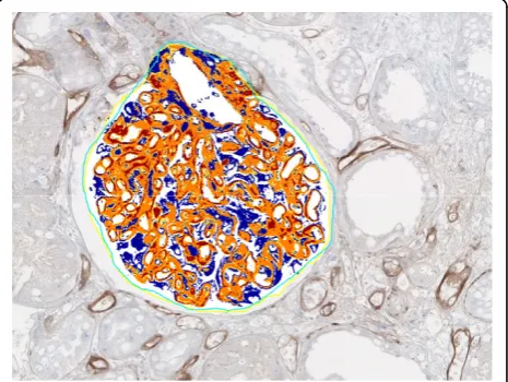 Figure 1 Automated image analysis in glomerular tissue. Manuallyselected glomeruli were analysed with Aperio Positive Pixel Countalgorithm