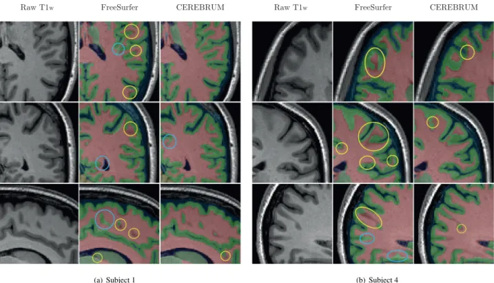 Fig. 2. Out-of-the-scanner (contrast enhanced) T1  w  scan (left), FreeSurfer segmentation (middle), and the result produced by our model (right)
