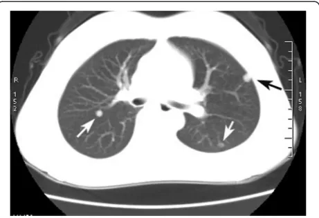 Fig. 1 On lung window image of the chest computed tomography(CT) scan, three 3–5 mm-sized, well-defined, round nodule areseen in the bilateral pulmonary lobes, and one nodule is revealedbeneath the pleura (black arrow)