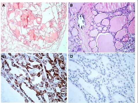 Fig. 2 a A well-circumscribed thyroid tissue in the pulmonary parenchyma (hematoxylin and eosin, 20 × magnification)