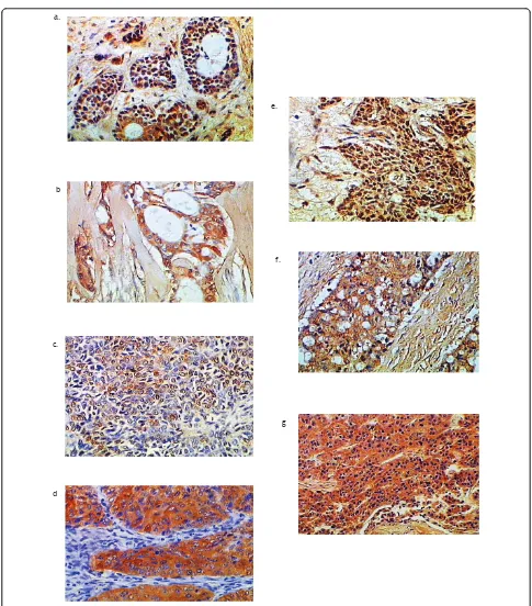 Figure 1 Maspin expression patterns in salivary gland carcinomas. a: low grade MECx200