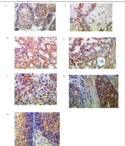 Figure 2 MCM2 expression patterns in salivary gland carcinomas. a: high grade MECx200