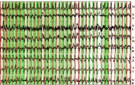 Fig. 5. T I,effects. However, the interpretation of clusters for the real data is more complicated and ambiguous