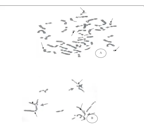Figure 1 BMB sections by (H & E staining): (A) Severe hypoblastic marrow: marked increase in fat space more than 80%