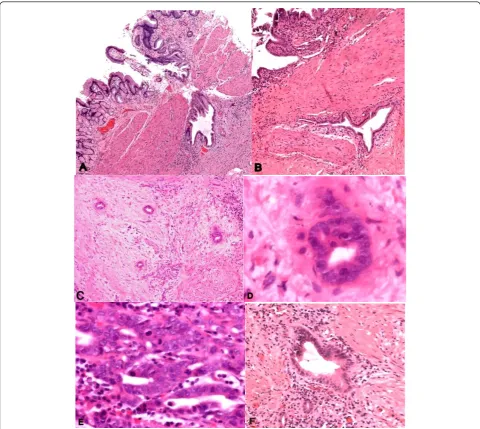 Figure 1 Benign mimicking malignant, and malignant mimicking benign in the gallbladder