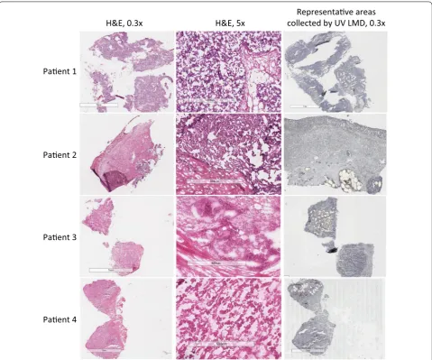 Fig. 1 Micrographs of HGSOC tissue sections before and after tumor epithelial cell harvest by laser microdissection