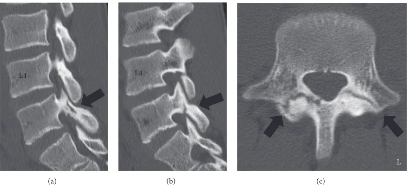 Figure 1: Reconstructed computed tomography (CT) scan of the lumbar spine from the first visit to a previous doctor’s office