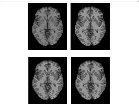 Figure 3 The segmentation results of applying EM1 and NWEM on a slice of image with 7% Rician noise