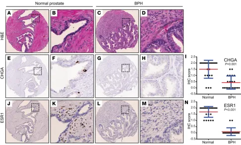 Figure 4. IHC on prostate TMA identifies altered ESR1+cells in BPH. (BPH-matched pair