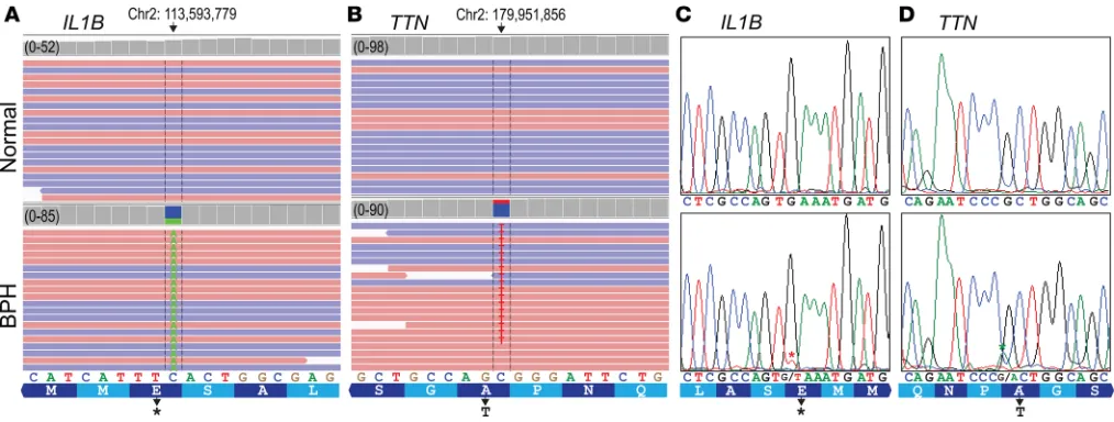 Figure 6. WES reveals somatic SNVs in BPH nodules. (A) Integrated Genome Viewer (IGV) display of mapped reads from WES of BPH and matched normal DNA within the IL1B gene