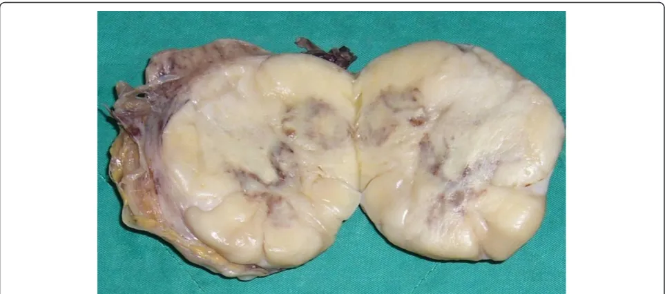 Figure 1 CT of the abdomen. Arterial phase images of dynamiccomputed topography scan showed a highly necrotic tumorcompressing the renal parenchyma without either invasion tosurrounding tissues or local lymphadenopathy.