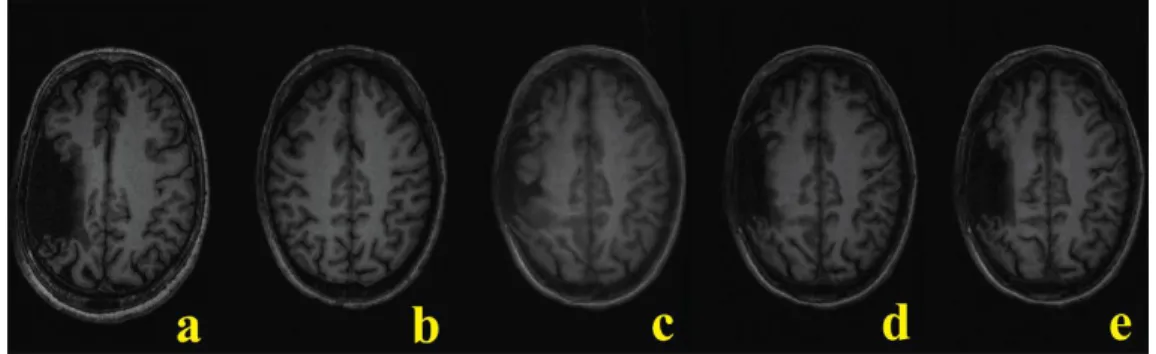 Figure 2-2: Stroke image registration. 