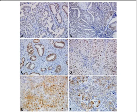 Figure 1 HNF-1nuclear expression of HNF-1differentiated adenocarcinoma showing strong expression of HNF-1(E)β expression in cervical carcinomas