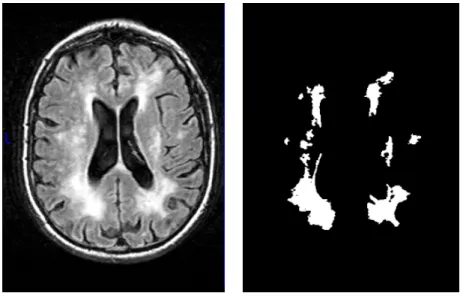 Figure 4.1 An example of the FLAIR image and the manual segmentation of white matter hyper-intensities from the corresponding axial slice.