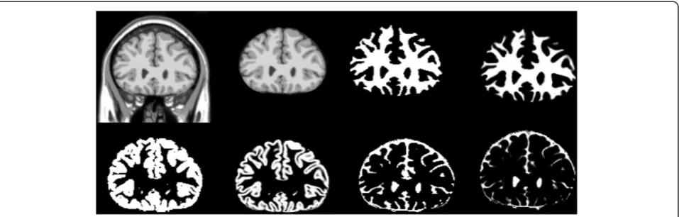 Figure 7 Results of segmentations on the simulated images fom Brainweb, left to right, top to bottom; simulated image, Extractedbrain image, Estimated WM, ground truth of WM, Estimated GM, ground truth of GM, Estimated CSF, ground truth of CSF.