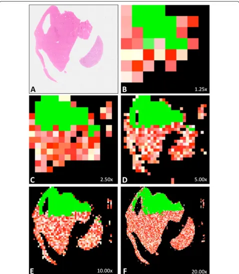 Figure 1 Automatic quality analysis of a virtual slide (parameter used: blur). A represents the thumbnail of a whole slide image (H&Estaining) whose upper third part is in focus and lower two thirds part is totally out of focus