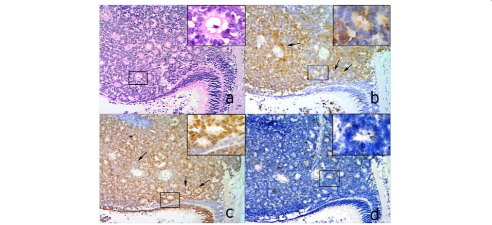 Figure 1 Expressions of p16INK4a, CRX and Ki67 in a representative RB case from RC group (100x)