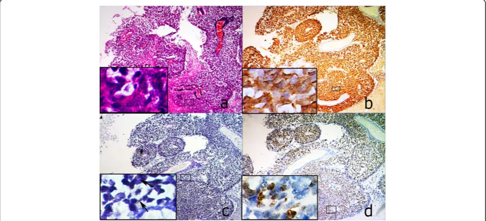 Figure 3 Expressions of p16INK4a, CRX and Ki67 in different histological phenotypes of one RB case from HWR group (100×)