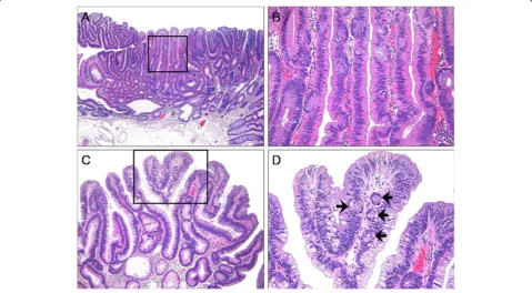 Figure 1 Histologic findings of traditional serrated adenoma (TSA). (A), TSA showing a protuberant growth pattern and serrated architecture(hematoxylin and eosin; original magnification × 40)