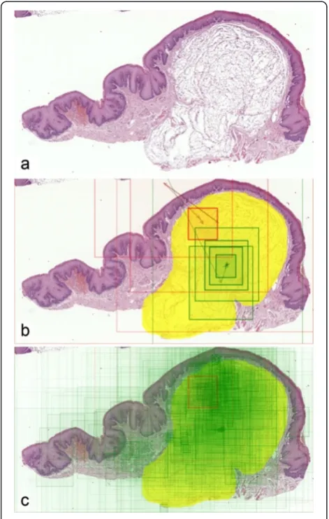 Figure 1 Visualization process for a question containing a WSIdemonstrating submucosal lipoma
