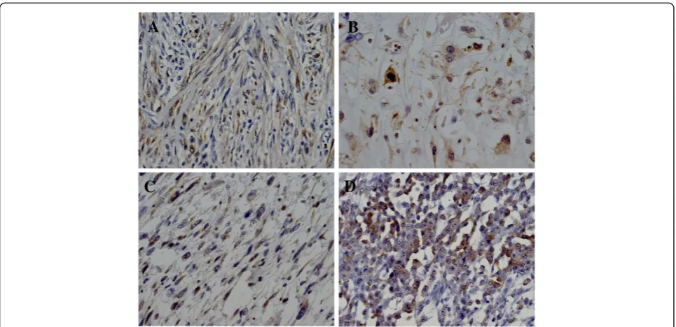 Figure 1 Representative maspin immunoreactivity in a leiomyosarcoma (A), liposarcoma (B), myxofibrosarcoma (C) and epithelioidsarcoma (D)