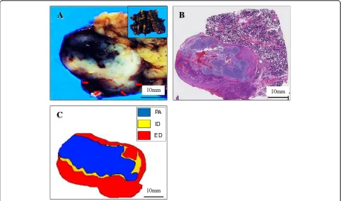 Figure 1 Cytomorphologic examination of the fine needle aspiration specimens. (A) The cytology specimens were inadequate, butconsisted of few small clusters of cohesive and three-dimensional pleomorphic tumor cells in a papillary-like fashion (rt
