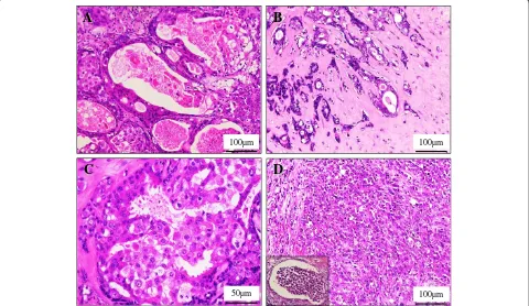 Figure 3 Microscopic examination of the invasive SDC ex PA. (A) In high power view, the ID components of SDC showed a proliferation ofhighly atypical epithelial cells having hyperchromatic pleomorphic nuclei and abundant eosinophilic cytoplasm, often arran