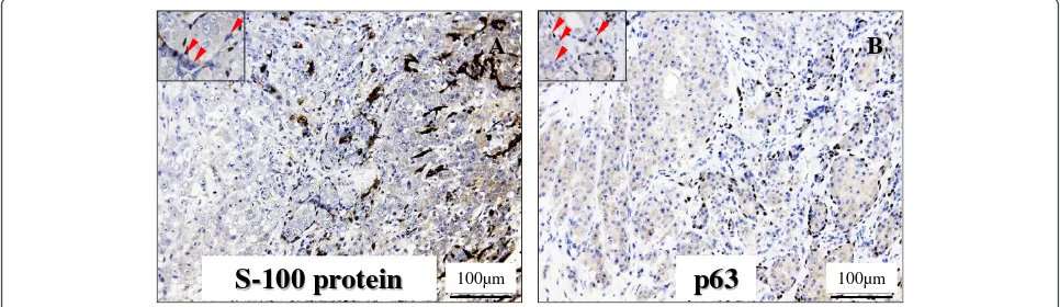 Figure 5 Myoepithelial markers analysis of the invasive SDC ex PA in immunohistochemistry.S-100 protein (side) (Original magnification × 200, Bar = 100mildly enlarged and hyperchromatic nuclei were sometimes negative for both of S-100 protein (A, inset) an